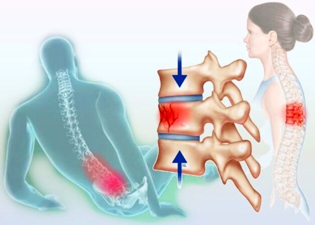 Même une blessure ordinaire peut déclencher le développement de l'ostéochondrose