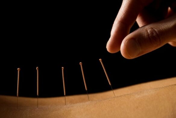 L'acupuncture aidera à se débarrasser des douleurs lombaires