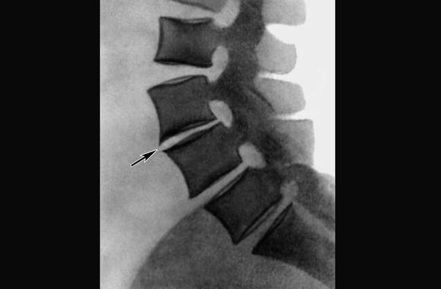 Manifestations d'ostéochondrose de la colonne thoracique sur une radiographie